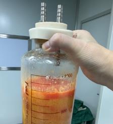 公主岭水动力吸脂手术要做多久？